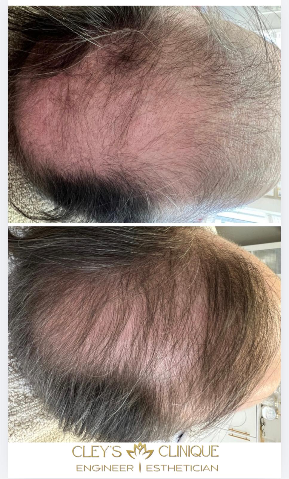 Hair Loss Treatment