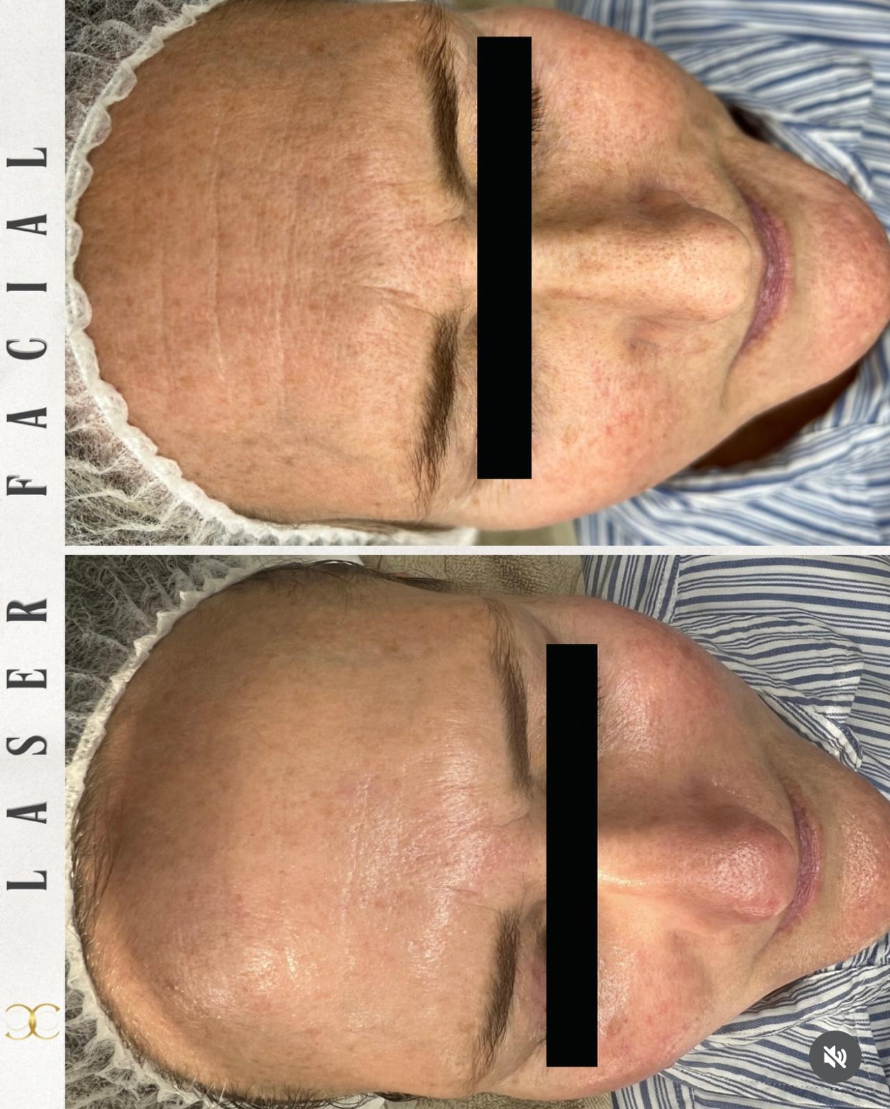 Anti-Age Treatment