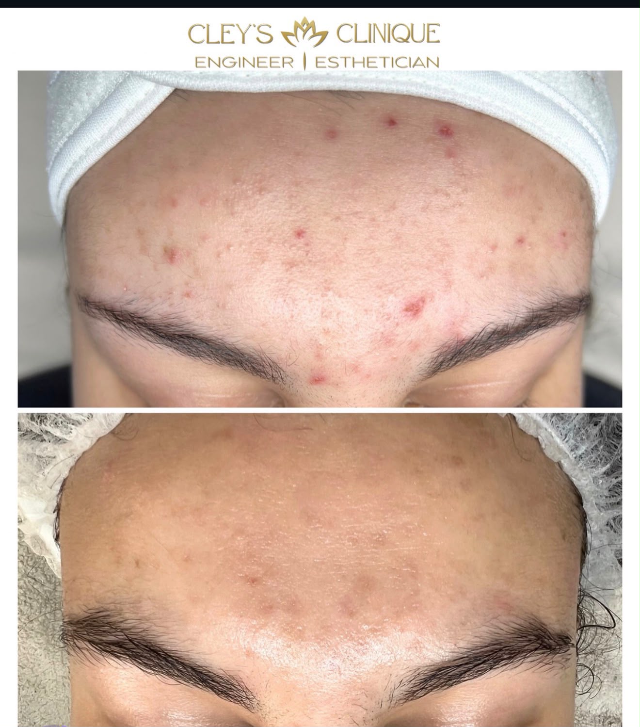 Acne Treatment